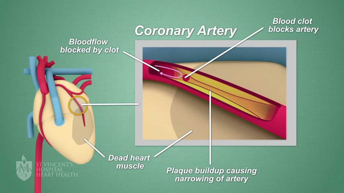 clogged arteries schematic diagram