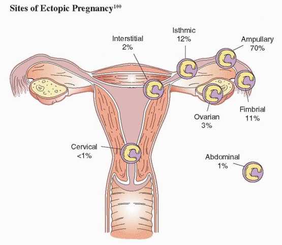 ectopic pregnancy schematic diagram