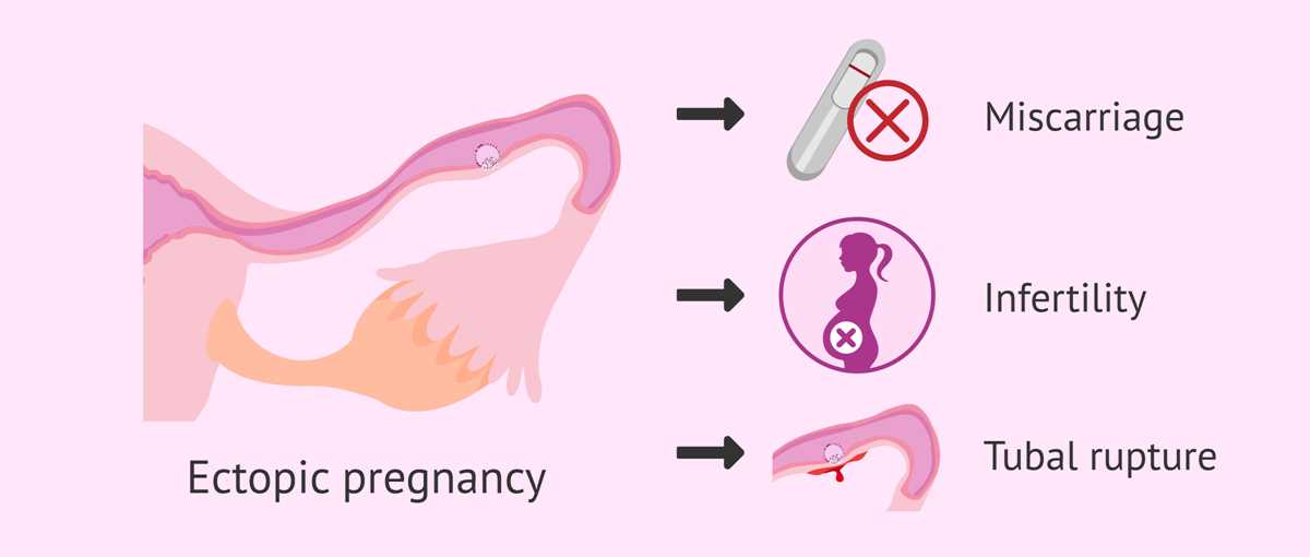 ectopic pregnancy schematic diagram