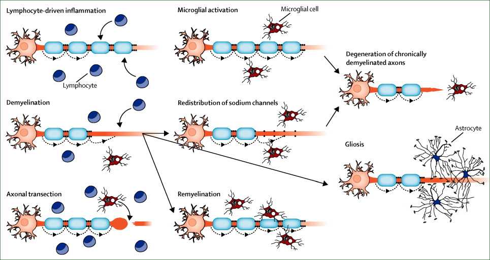 multiple sclerosis schematic diagram