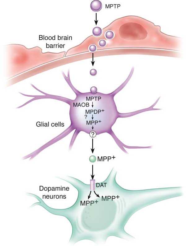 parkinsons disease pathophysiology schematic diagram
