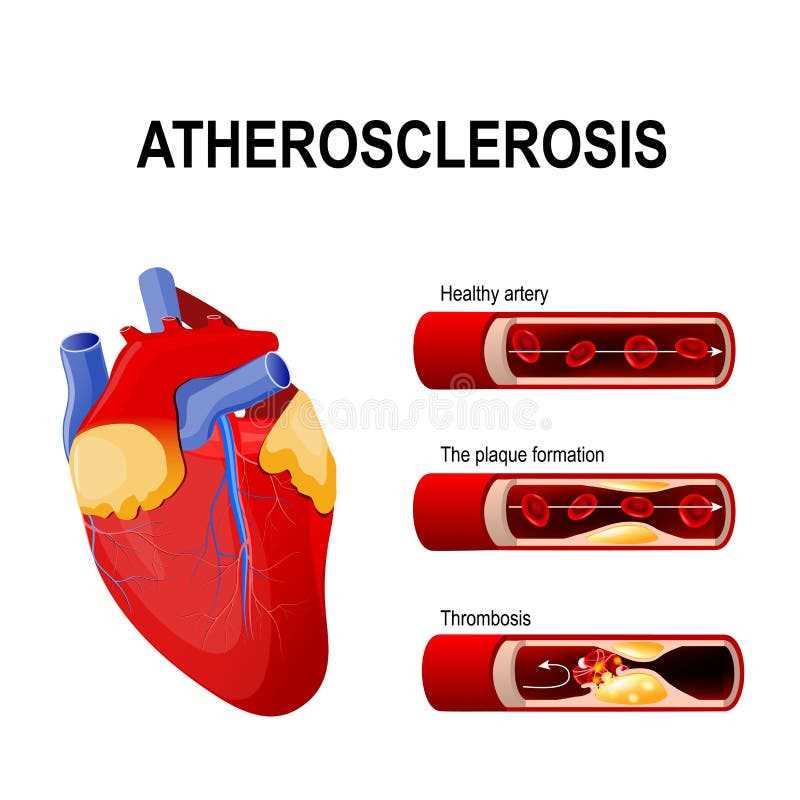 schematic diagram atherosclerosis