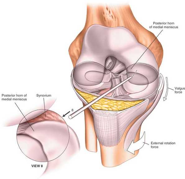 schematic diagram posterior horn medial meniscus
