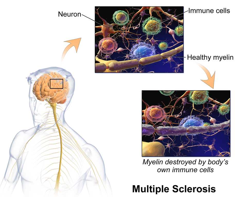 multiple sclerosis schematic diagram