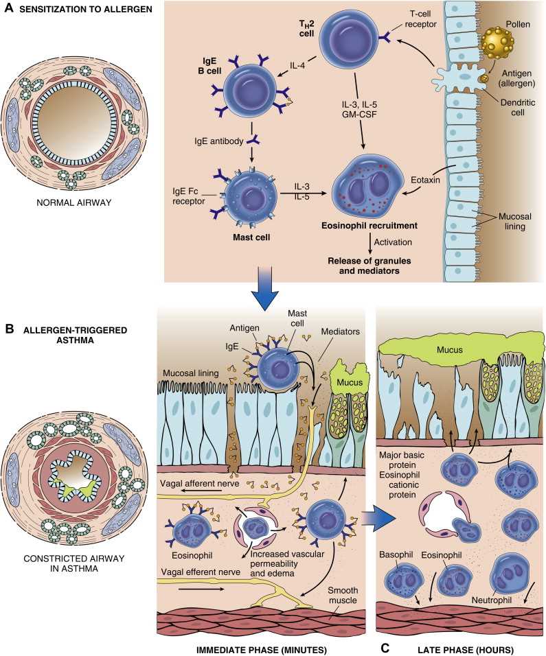 asthma pathophysiology schematic diagram