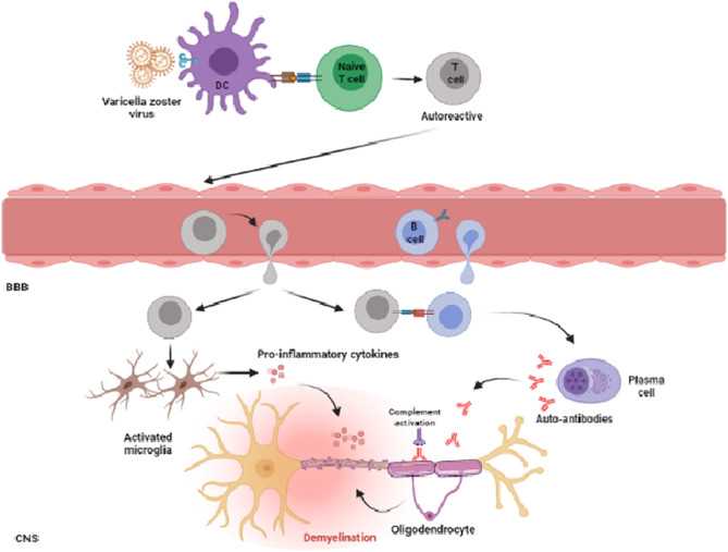 multiple sclerosis schematic diagram