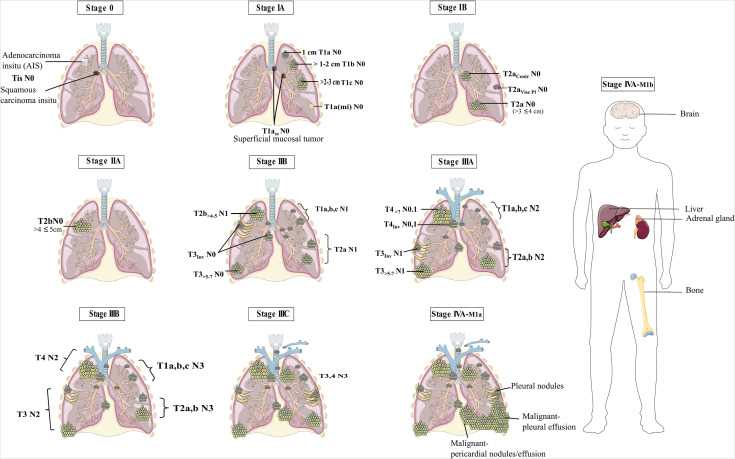 pathophysiology lung cancer schematic diagram