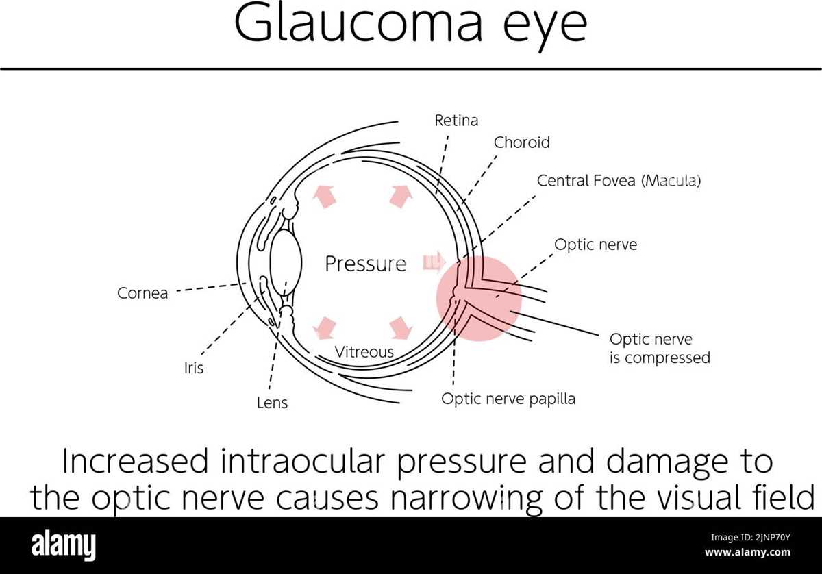 glaucoma pathophysiology schematic diagram