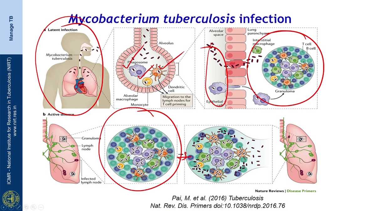 pathophysiology of pulmonary tuberculosis schematic diagram