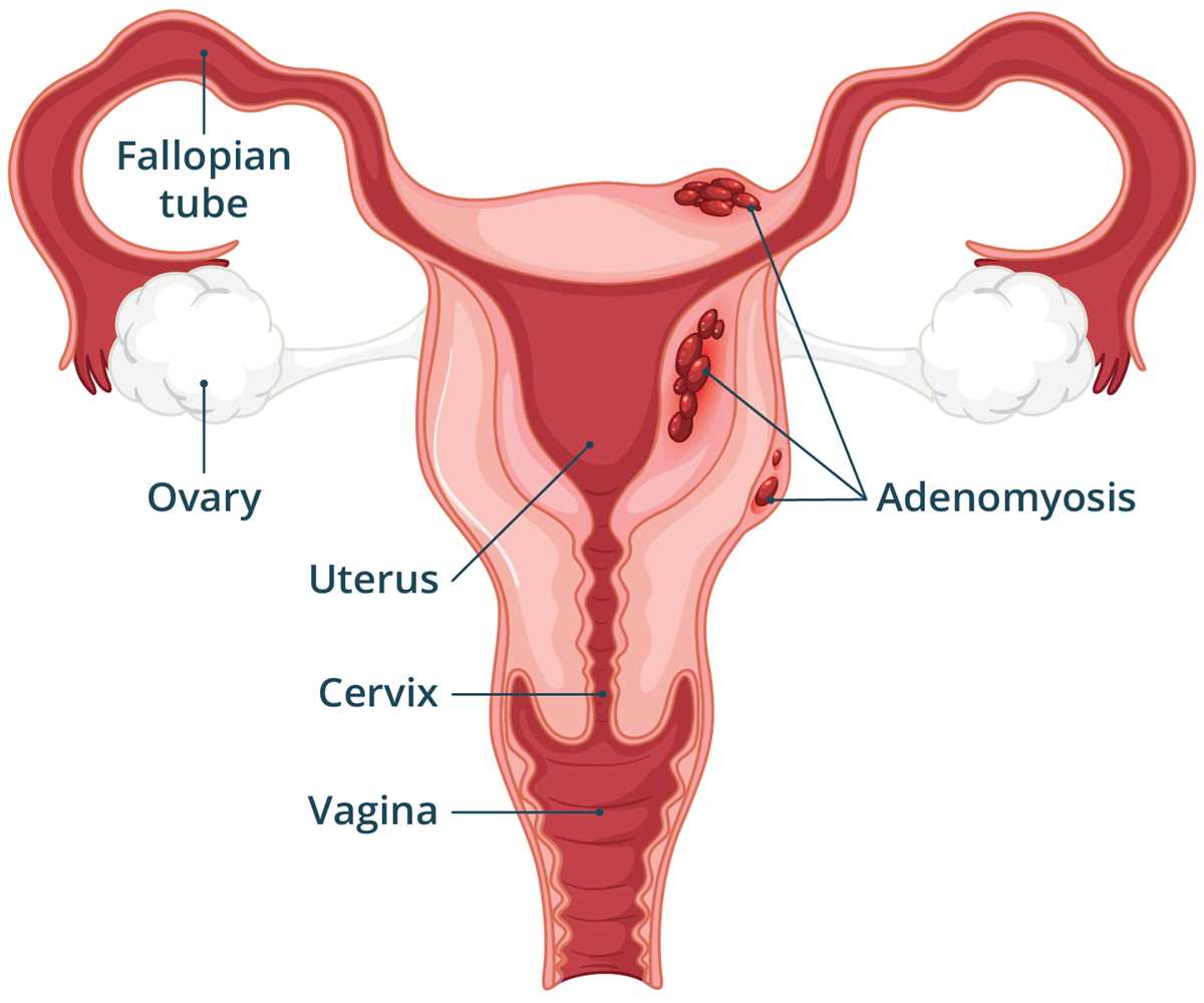 schematic diagram of adenomyosis