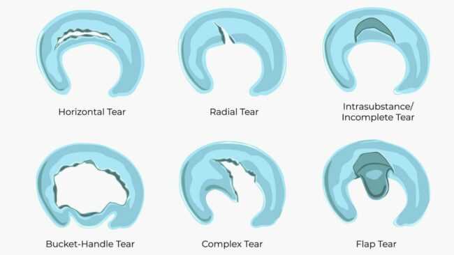 schematic diagram posterior horn medial meniscus
