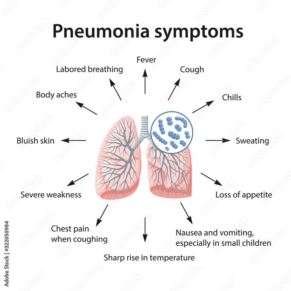 pneumonia schematic diagram